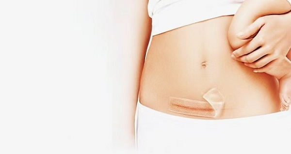 Kodėl stori silikono gelio randų lakštai tokie populiarūs?